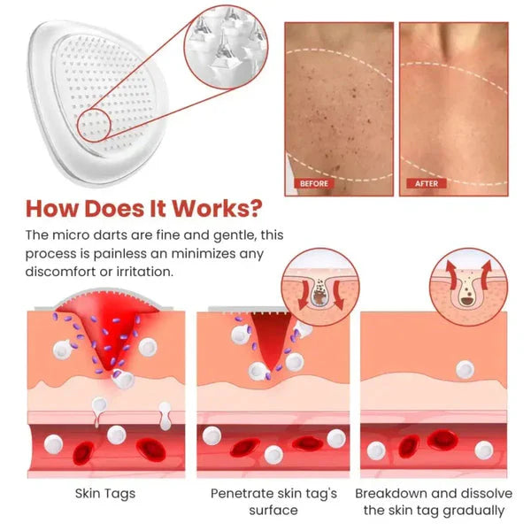 DermaSmooth Skin Tag Remover Patch